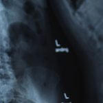 misdiagnosis