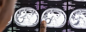 traumatic-brain-injury