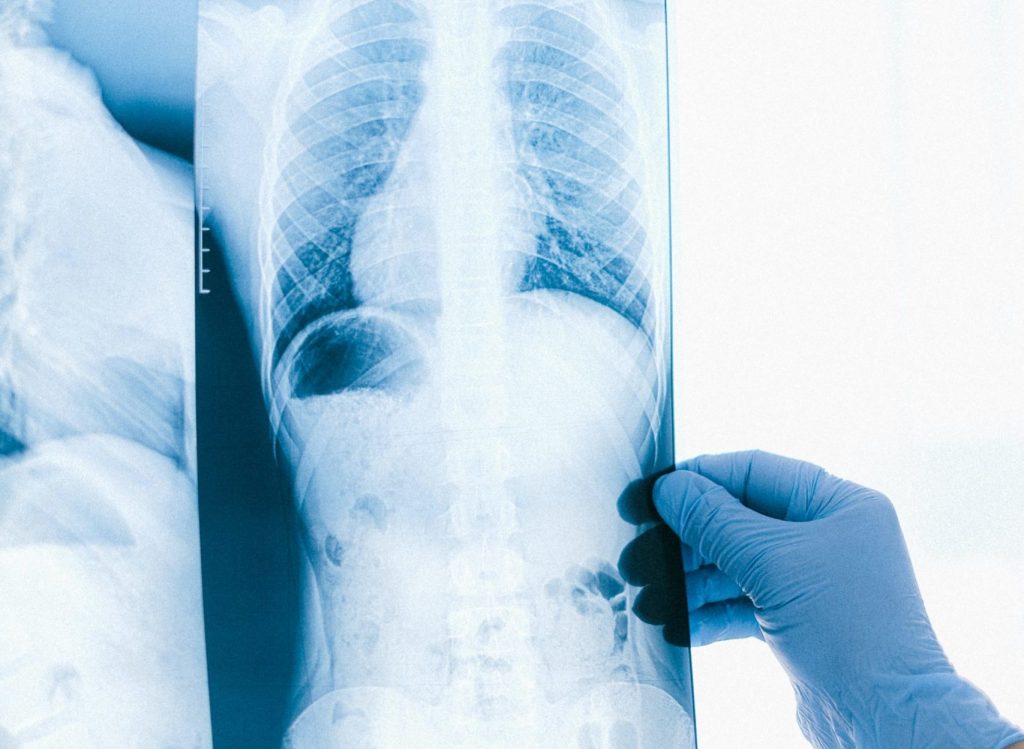 lungs xray