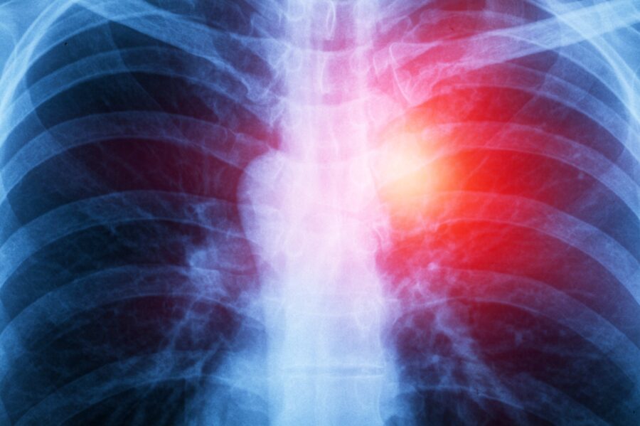 asbestos related mesothelioma